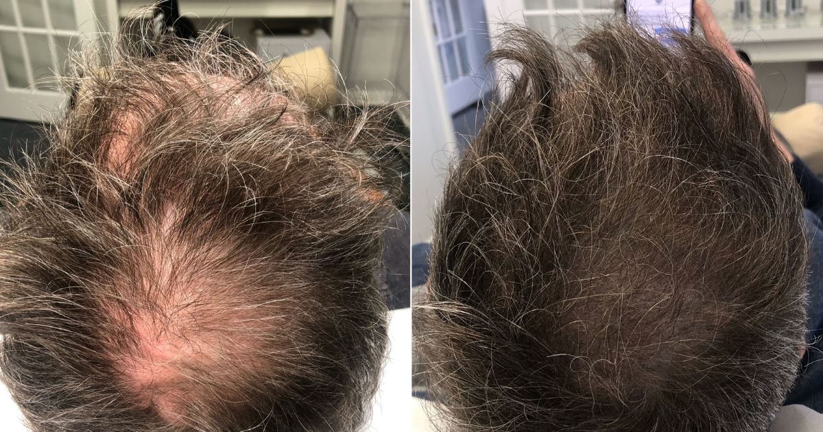 Non-medical Hair Restoration Treatment for Men and Women